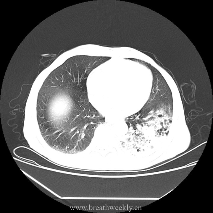 图片[4]-病例45 | 每周呼吸-每周呼吸