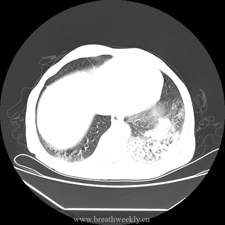 图片[6]-病例45 | 每周呼吸-每周呼吸