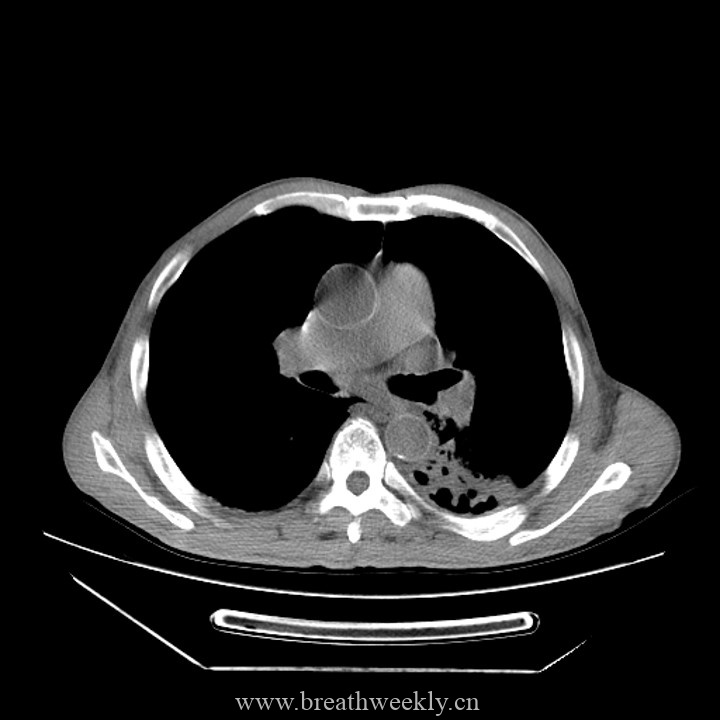 图片[7]-病例45 | 每周呼吸-每周呼吸