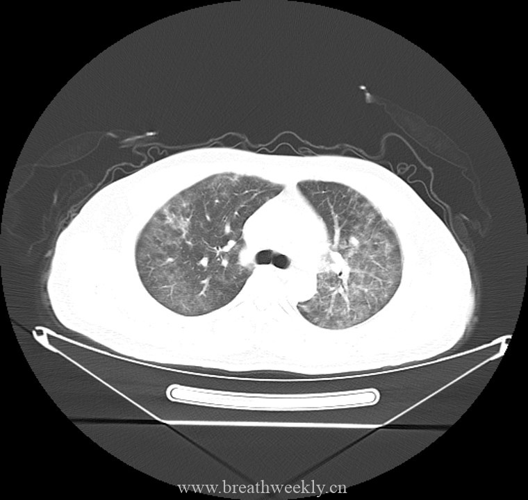 图片[1]-病例44 | 每周呼吸-每周呼吸