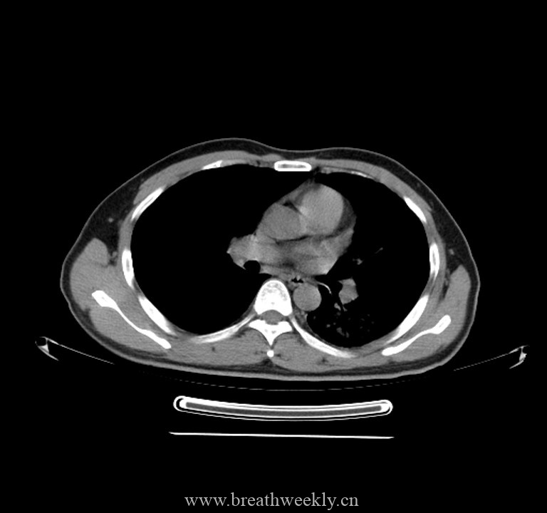 图片[10]-病例44 | 每周呼吸-每周呼吸