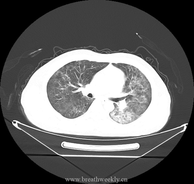 图片[3]-病例44 | 每周呼吸-每周呼吸