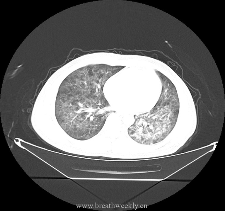 图片[6]-病例44 | 每周呼吸-每周呼吸