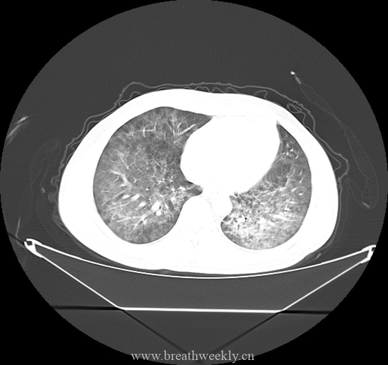 图片[7]-病例44 | 每周呼吸-每周呼吸