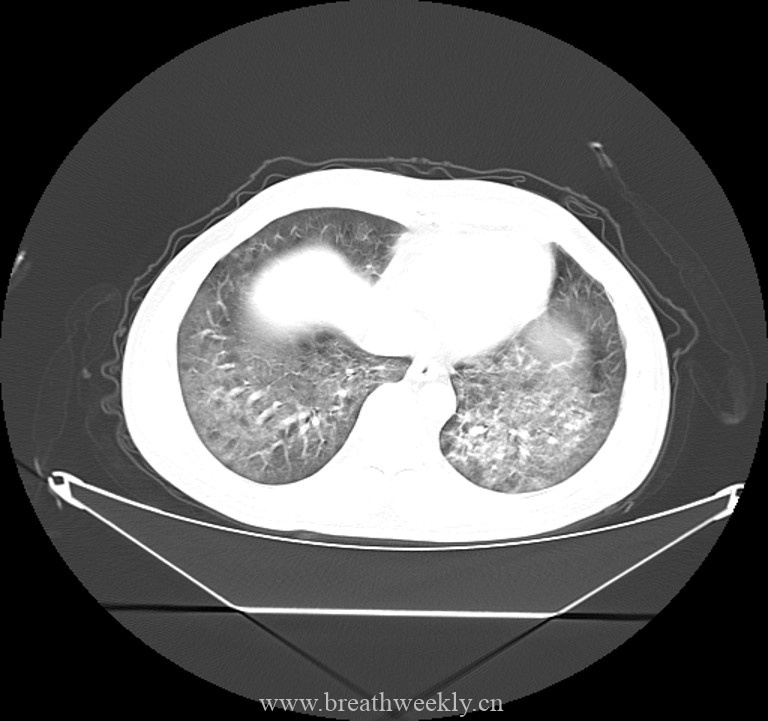 病例44-每周呼吸