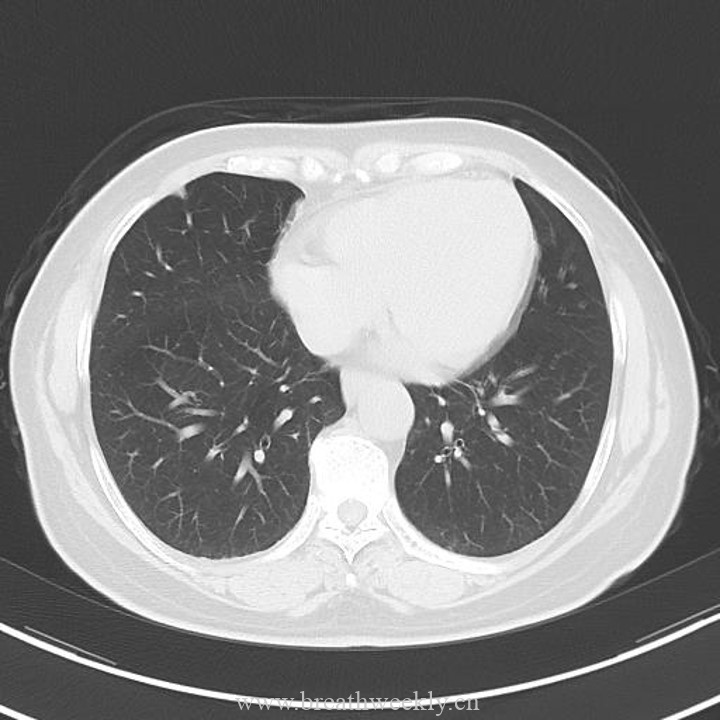 图片[16]-病例43 | 每周呼吸-每周呼吸