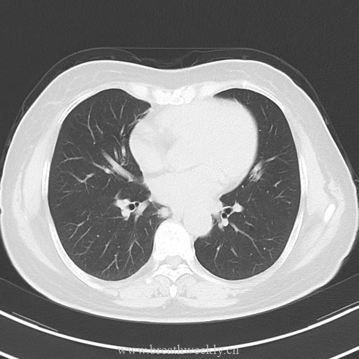 图片[10]-病例43 | 每周呼吸-每周呼吸