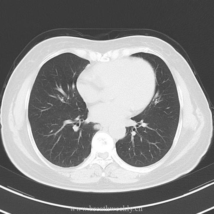图片[11]-病例43 | 每周呼吸-每周呼吸