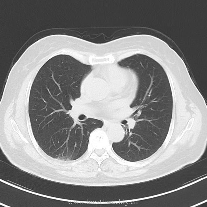 图片[6]-病例43 | 每周呼吸-每周呼吸
