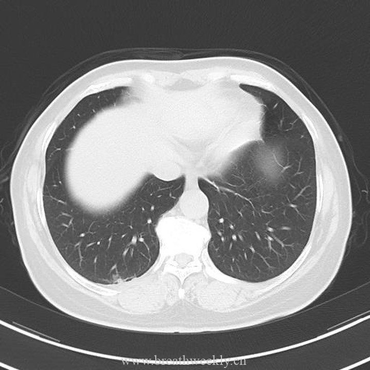 图片[20]-病例43 | 每周呼吸-每周呼吸