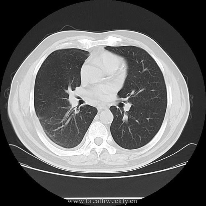 图片[11]-病例42 | 每周呼吸-每周呼吸