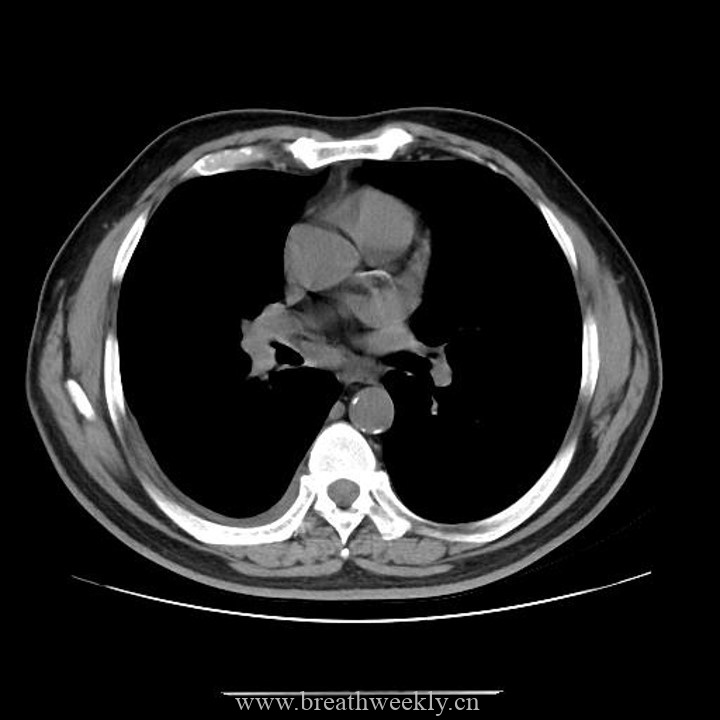 图片[18]-病例42 | 每周呼吸-每周呼吸