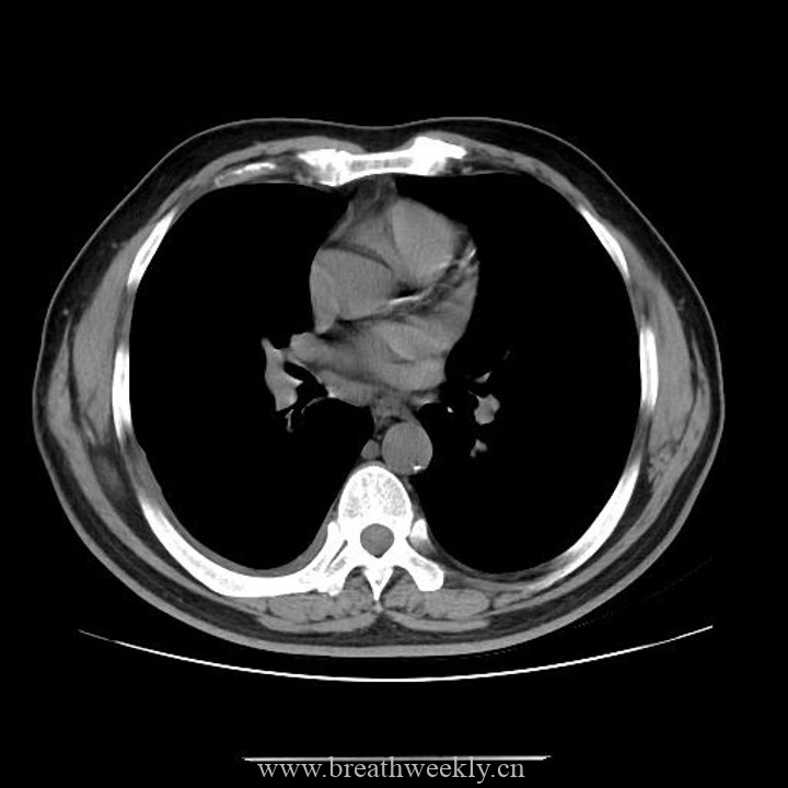 图片[19]-病例42 | 每周呼吸-每周呼吸