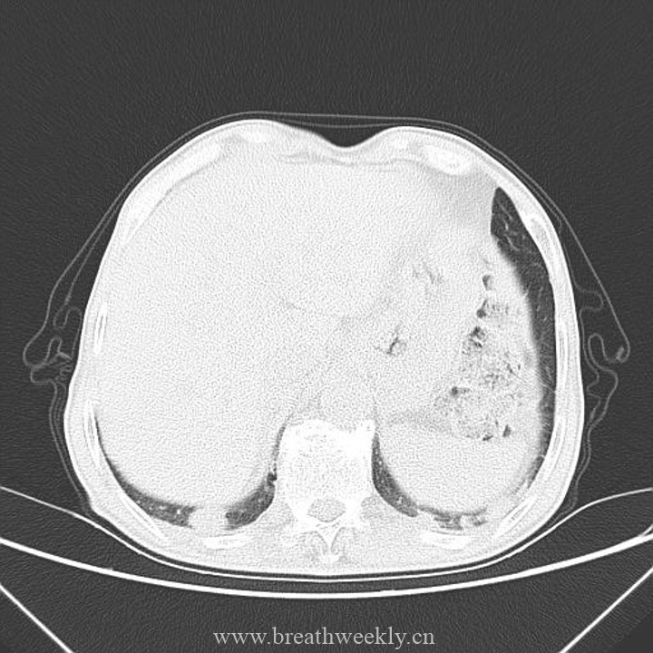 图片[12]-病例41 | 每周呼吸-每周呼吸