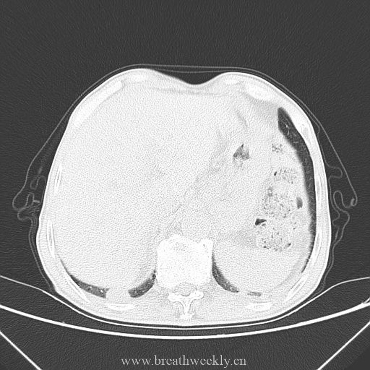 图片[13]-病例41 | 每周呼吸-每周呼吸