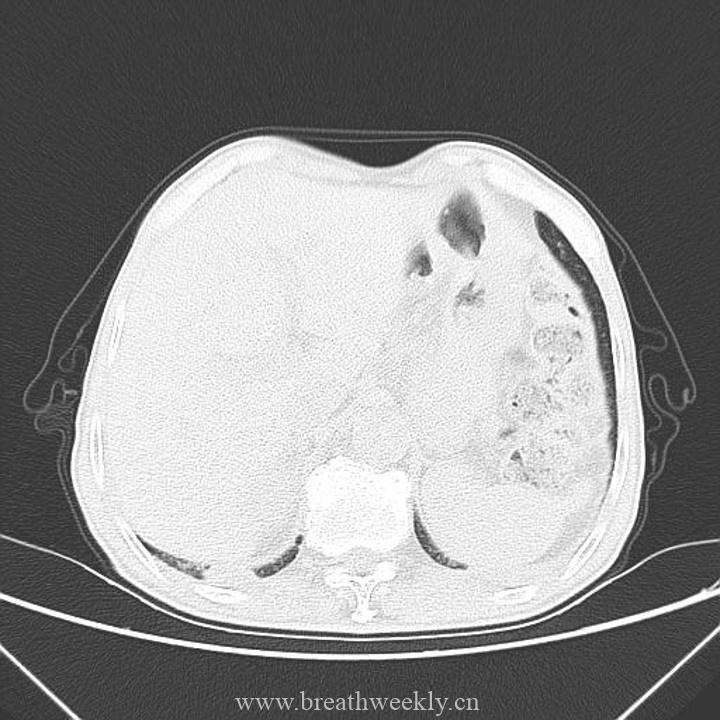 图片[14]-病例41 | 每周呼吸-每周呼吸