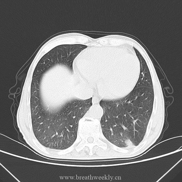 图片[4]-病例41 | 每周呼吸-每周呼吸