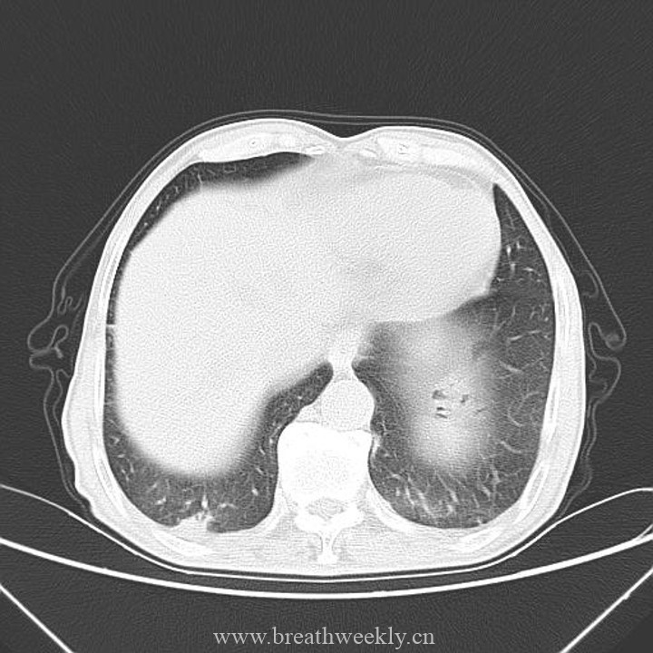 图片[8]-病例41 | 每周呼吸-每周呼吸