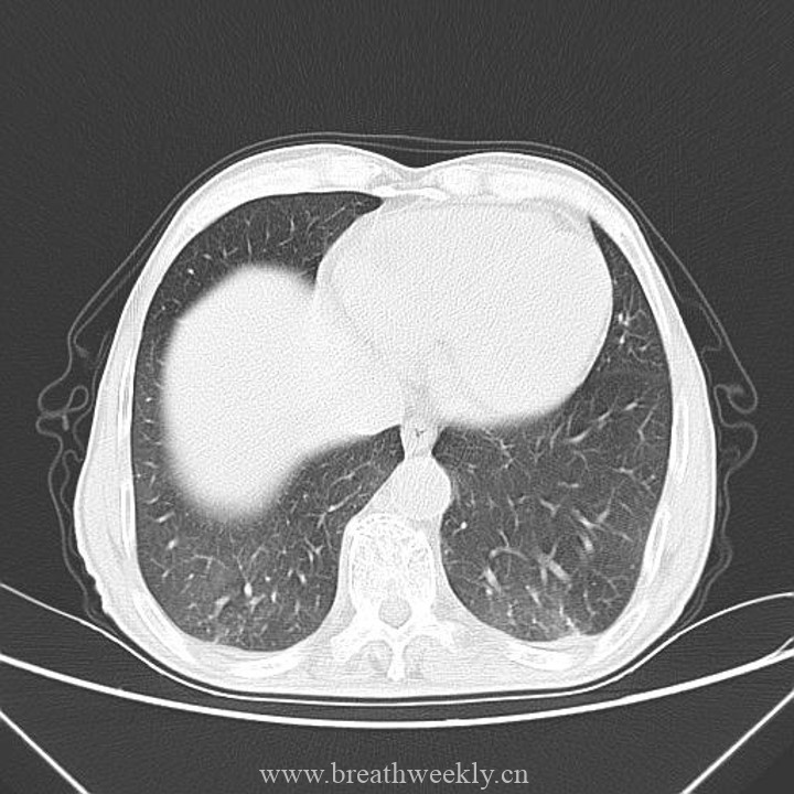 图片[5]-病例41 | 每周呼吸-每周呼吸