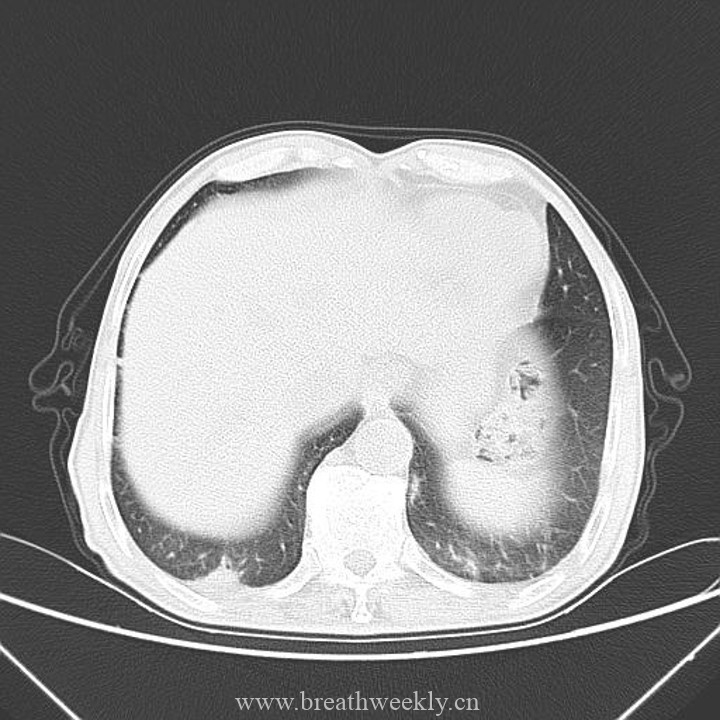 图片[9]-病例41 | 每周呼吸-每周呼吸