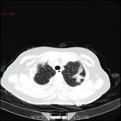 病例63-每周呼吸