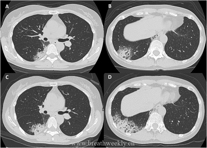 图片[8]-急性纤维素性机化性肺炎（AFOP） | 每周呼吸-每周呼吸
