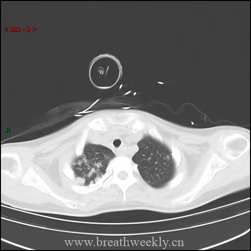 图片[1]-病例64 | 每周呼吸-每周呼吸