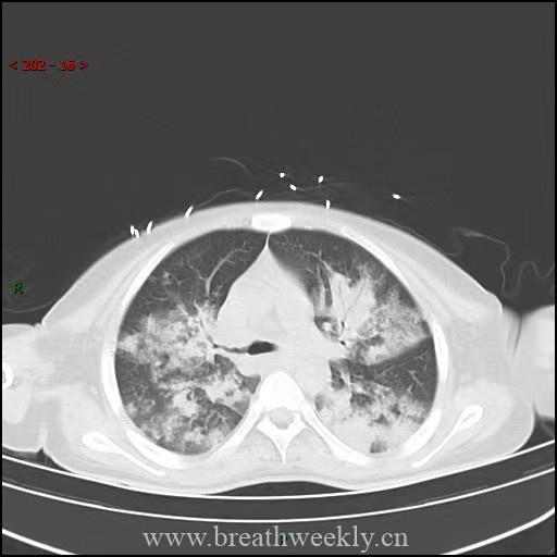 图片[4]-病例64 | 每周呼吸-每周呼吸