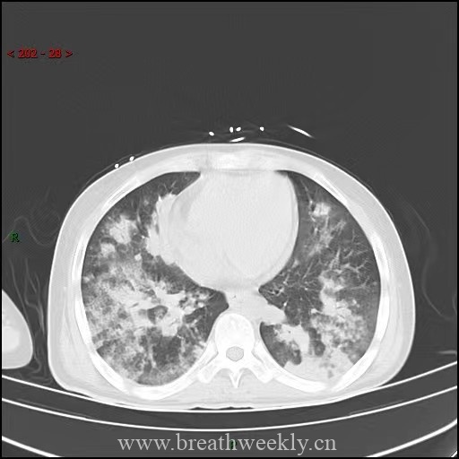 图片[10]-病例64 | 每周呼吸-每周呼吸