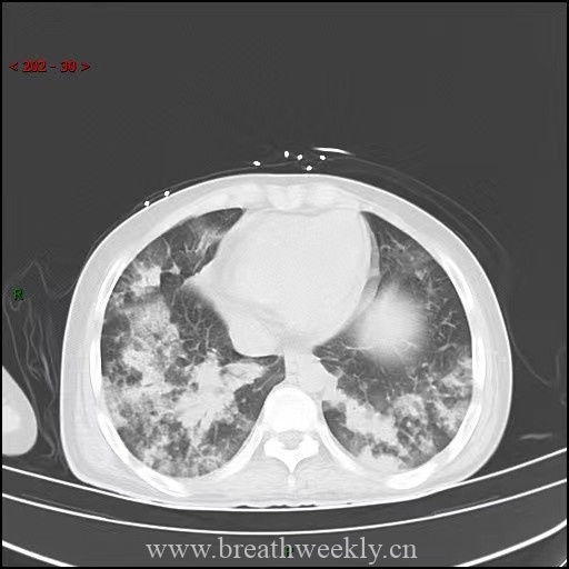 图片[11]-病例64 | 每周呼吸-每周呼吸
