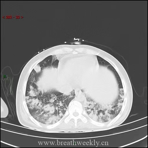 图片[12]-病例64 | 每周呼吸-每周呼吸