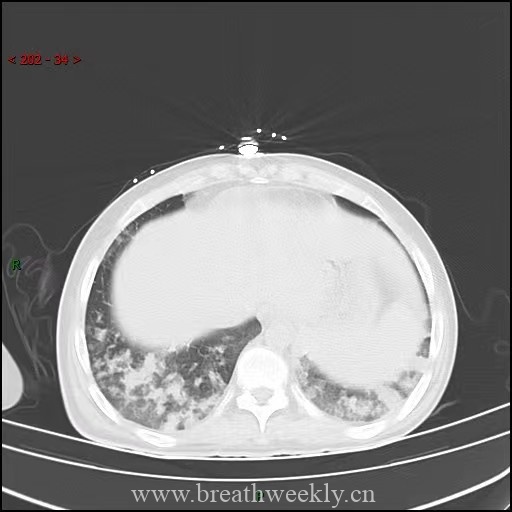 图片[13]-病例64 | 每周呼吸-每周呼吸