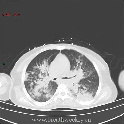 图片[5]-病例64 | 每周呼吸-每周呼吸