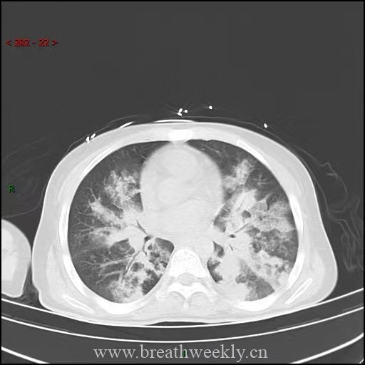 图片[7]-病例64 | 每周呼吸-每周呼吸