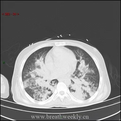 图片[8]-病例64 | 每周呼吸-每周呼吸