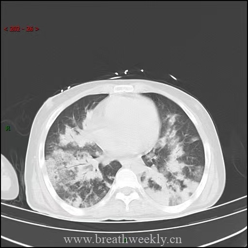 图片[9]-病例64 | 每周呼吸-每周呼吸