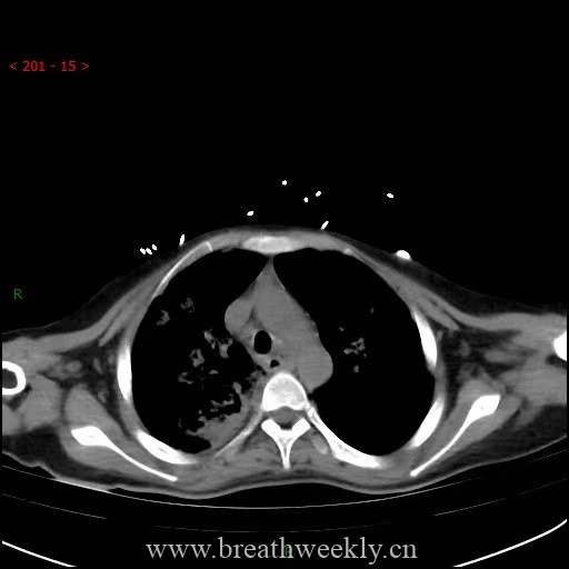 图片[19]-病例64 | 每周呼吸-每周呼吸