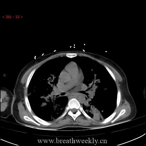 图片[21]-病例64 | 每周呼吸-每周呼吸