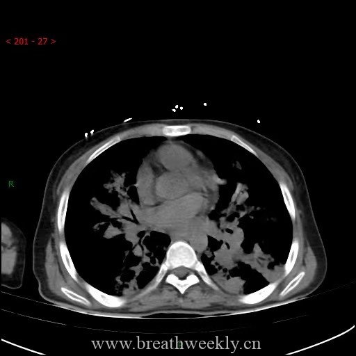 图片[22]-病例64 | 每周呼吸-每周呼吸