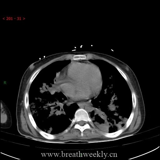图片[23]-病例64 | 每周呼吸-每周呼吸
