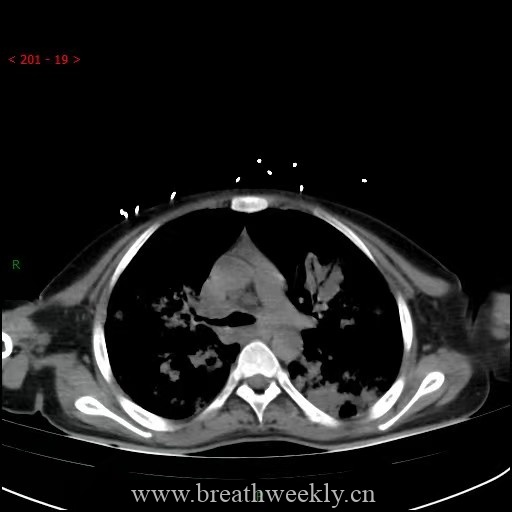 图片[20]-病例64 | 每周呼吸-每周呼吸
