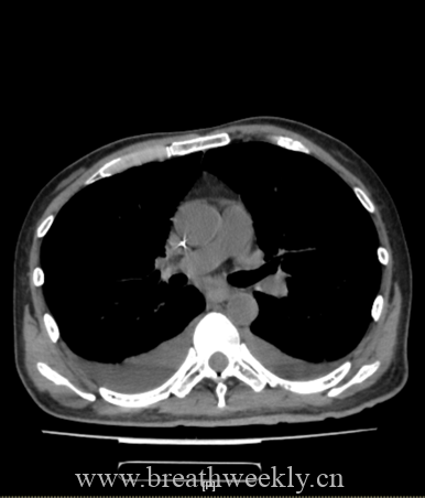 图片[17]-病例66 | 每周呼吸-每周呼吸