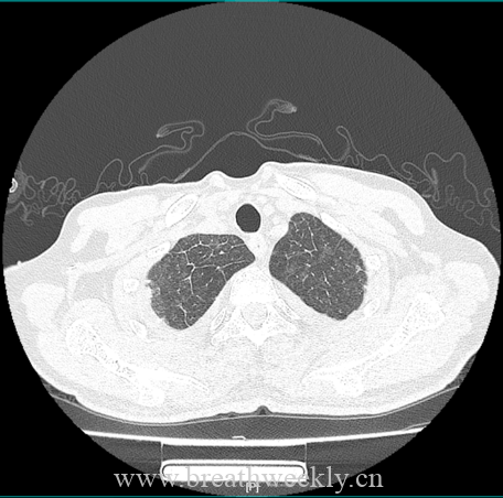 图片[1]-病例66 | 每周呼吸-每周呼吸