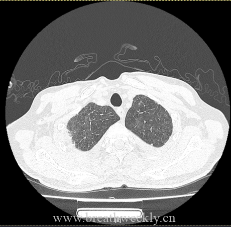图片[2]-病例66 | 每周呼吸-每周呼吸