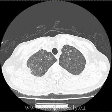 图片[3]-病例66 | 每周呼吸-每周呼吸