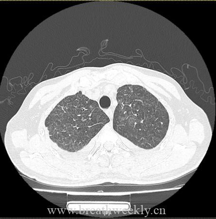 病例66-每周呼吸