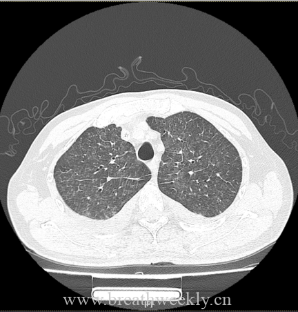 图片[6]-病例66 | 每周呼吸-每周呼吸