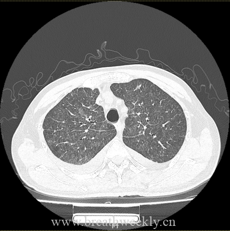 图片[8]-病例66 | 每周呼吸-每周呼吸