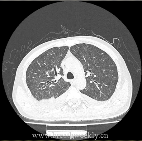 图片[12]-病例66 | 每周呼吸-每周呼吸