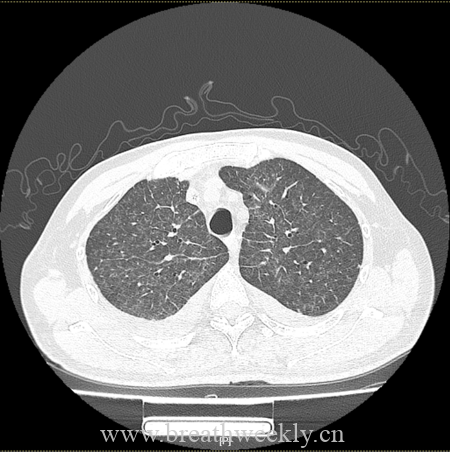 图片[7]-病例66 | 每周呼吸-每周呼吸